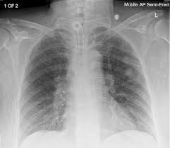 Coronavirus Swab Gets Stuck In Patient S Lung While Having Test Carried Out After Surgery Mirror Online