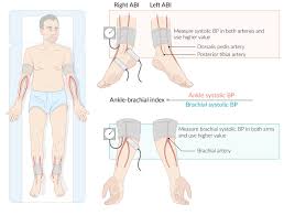 The ankle brachial index is used to estimate if a person is subjected to the peripheral artery disease (pad). Peripheral Arterial Disease Amboss
