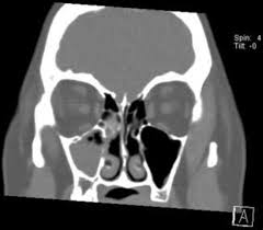 Mucous retention cysts typically located in sinuses only. Chronic Rhinosinusitis Nasal Polyps Melbourne Ent Group