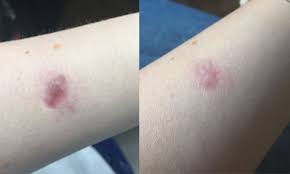 Maybe you would like to learn more about one of these? Scar Fading Treatment Allure