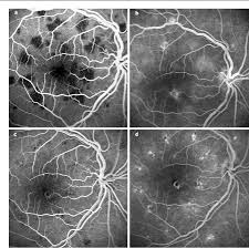 Apmppe abbreviation stands for acute posterior multifocal placoid pigment epitheliopathy. Figure 2 From Correlation Between Optical Coherence Tomography And Autofluorescence In Acute Posterior Multifocal Placoid Pigment Epitheliopathy Semantic Scholar