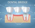Dental Bridges India | Fixed Partial Dentures in India | Save ...
