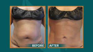 Check spelling or type a new query. Sono Bello Laser Liposuction Tummy E X Mini Tummy Tuck Youtube