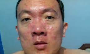Cacar air bisa menginfeksi pada kemaluan yang nantinya terjadinya herpes genital. Cara Menghilangkan Cacar Air Dengan Cepat
