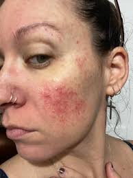 Dermatologists treating hidradenitis suppurativa in Los Angeles