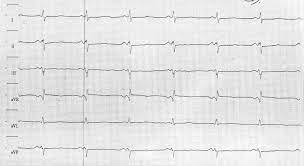 Pq Intervall Fokus Ekg