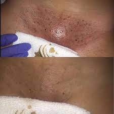 Hi, i am 16 and i have little dark marks and scars all over my vagina area from shaving my vagina. Yoni Spa Room A Vajacial Is Performed On Your Vulva Facebook
