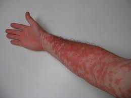 (2015) amoxicillin rash in patients with infectious mononucleosis: Amoxil Vs Amoxicillin Description And Brand Names