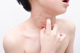 Apa penyebabnya dan bagaimana cara menghilangkan jerawat yang sering timbul di badan? Cara Menghilangkan Gatal Cacar Air Untuk Menghindari Infeksi Kulit