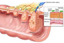 Often many colon and rectal cancer patients initially thought they had hemorrhoids because of symptoms such as rectal itching and rectal bleeding. Hemorrhoids Or Colon Cancer Health Care Qsota