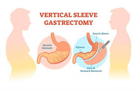 lose weight fast with gastric sleeve
