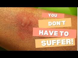 Image result for mosquito bite