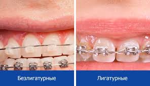 Металлическая брекет система состоит из: Metallicheskie Brekety Cena Vidy Sistem Ustanovka Novadent Moskva