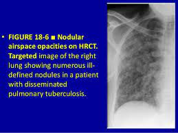 18 Airspace Diseases Dr Muhammad Bin Zulfiqar