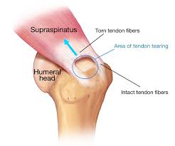 Image result for Rotator Cuff Injury