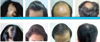 A brief history of hair loss products. Hair Growth Laser Helmet For Hair Loss Treatment With Laser Lights 272 Diodes Buy Hair Growth Helmet With Flashing Light Medical Hair Product On Alibaba Com