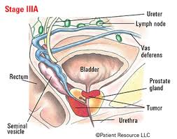 If your diagnosis is thyroid cancer, you may be able to breathe a bit easier, as it's one of the most treatable cancers when caugh. Patient Resource Publishing Advanced Prostate Staging