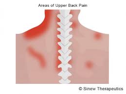 If a nerve in this area is injured, irritated, or. Upper Back Muscle Strains Information Sinew Therapeutics