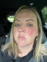 Does anyone else get little lumps like this from tigging? It's been