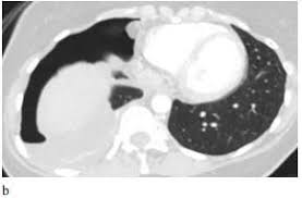 Current and future medical therapies vercellini p, et al. Spontaneous Catamenial Pneumothorax Due To Thoracic Endometriosis Syndrome A Case Series