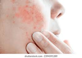 Image result for red rash face