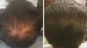 *free* shipping on qualifying offers. Do Led Devices Help Regrow Thinning Hair Wwltv Com