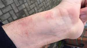 And sometimes, it's a lot easier than you think. What You Need To Know About These Apple Watch Skin Irritation Complaints