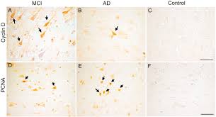 Image result for alzheimer 1981 2021