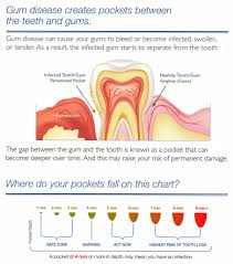 What Is Periodontal Charting Matthews Periodontics