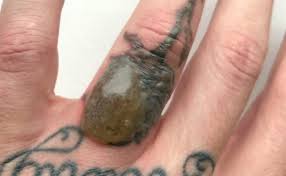 Crow studios 29 great northern road derby, de1 1lr. What Happens When Tattoo Removal Goes Wrong Man S Left With Grim Blister