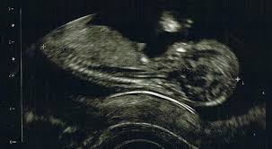 Fts) bekannte testverfahren, wird anhand verschiedener faktoren, das risiko einer vorliegenden chromosomenstörung bei dem noch ungeborenen. Erfahrungen Ersttrimesterscreening In Der 13 Woche Model Und Mama