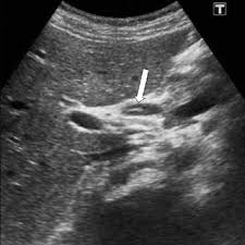 Patient had a maximum flow rate of 11.3 ml/s and an average flow rate of 7.4 ml/s in uroflowmetry. Gharbi And Who Classification Of Hydatid Cysts Disease Of The Liver Download Table