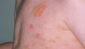 Image result for Urticaria pigmentosa children