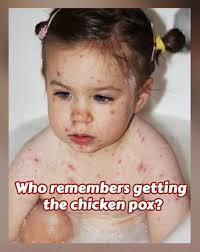 Did you get the chicken pox when you were younger?