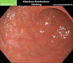 Gastroenteritis is often called the stomach flu, even though it's not a type of flu at all. Gastroenteritis Doccheck