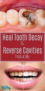 Top Reverse Cavities Choices Healthy Medicine Tips Tooth Decay Remedies Teeth Health Dental Decay