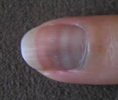 Check spelling or type a new query. White Spots On Nails Causes Prevention And Treatment