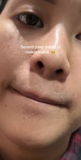 maskerjerawat