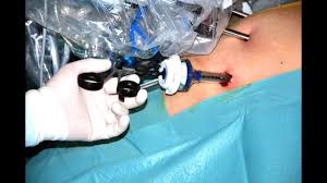 Elle peut se produire en cas il existe deux types d'opérations : SecÅ£ia Chirurgie GeneralÄƒ Ii Spitalul Universitar De UrgenÅ£Äƒ Militar Central Dr Carol Davila