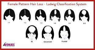 More than 21 million women in the u.s. What Determines If A Woman Is A Good Candidate For Hair Transplant Surgery Hair Transplant Women Female Pattern Hair Loss Hair Loss