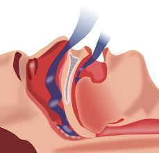 Related to the treatment of illness and injuries: Obstructive Sleep Apnea Wikipedia