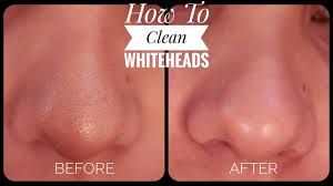 If you want to get rid of whiteheads and blackheads, you need to follow a regular skin hygiene. How To Remove Whiteheads From Nose Face 2019 Youtube