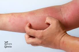 Image result for dermatitis contacta allergica