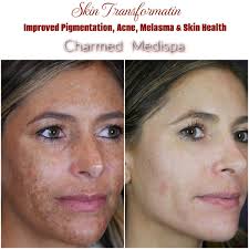 Image result for Melasma