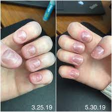 Long Term Acrylic Nails And Hypothyroidism Damage I Promise You They Ll Grow Back Calmhands