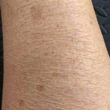 Solution for crepey skin at your home 1. I Have Terrible Dry Crepey Skin On My Legs I M Fit Have Muscle Tone Options Photos
