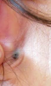 Hautveranderung Hinterm Ohr Gesundheit Blauer Fleck
