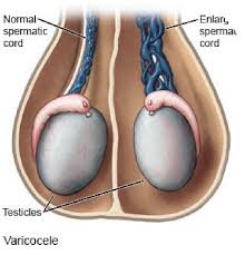 Image result for Varicocele
