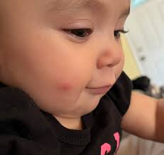 Any suggestions for treating red bumps