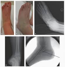 Image result for Ankle Dislocation